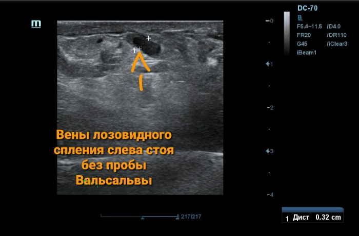 УЗИ вены лозовидного сплетения слева лежа без пробы Вальсальвы