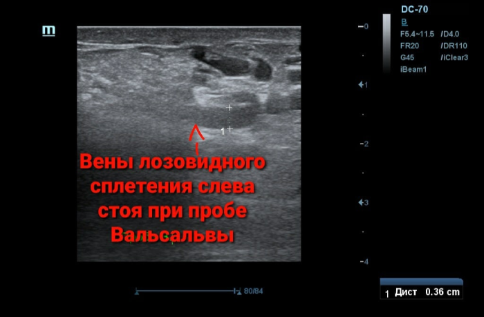 УЗИ вены лозовидного сплетения слева стоя при пробе Вальсальвы