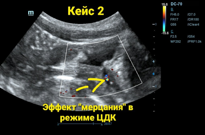 эффект мерцания в режиме ЦДК