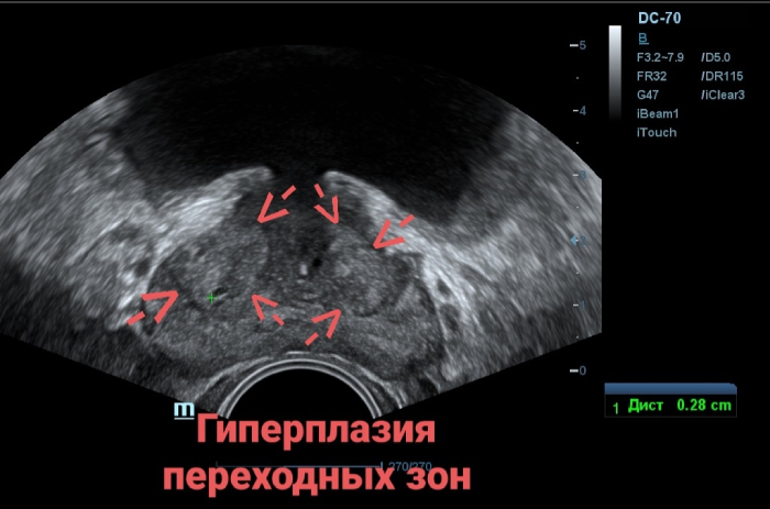 Гиперплазия переходных зон