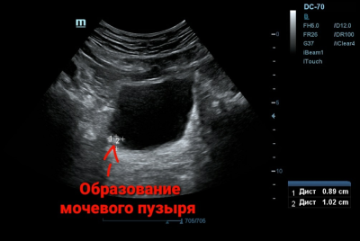 УЗИ, образование мочевого пузыря