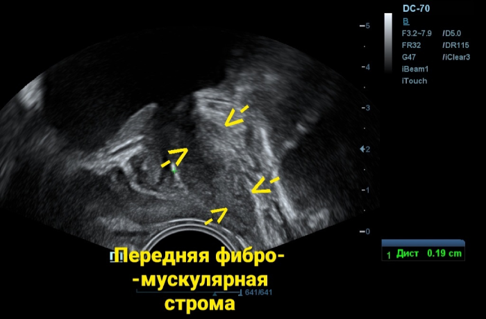 передняя фибро-мускулярная строма