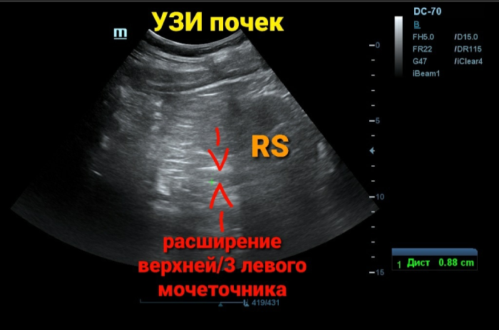 УЗИ почек расширение