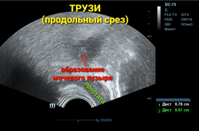 ТРУЗИ продольный срез, образование мочевого пузыря
